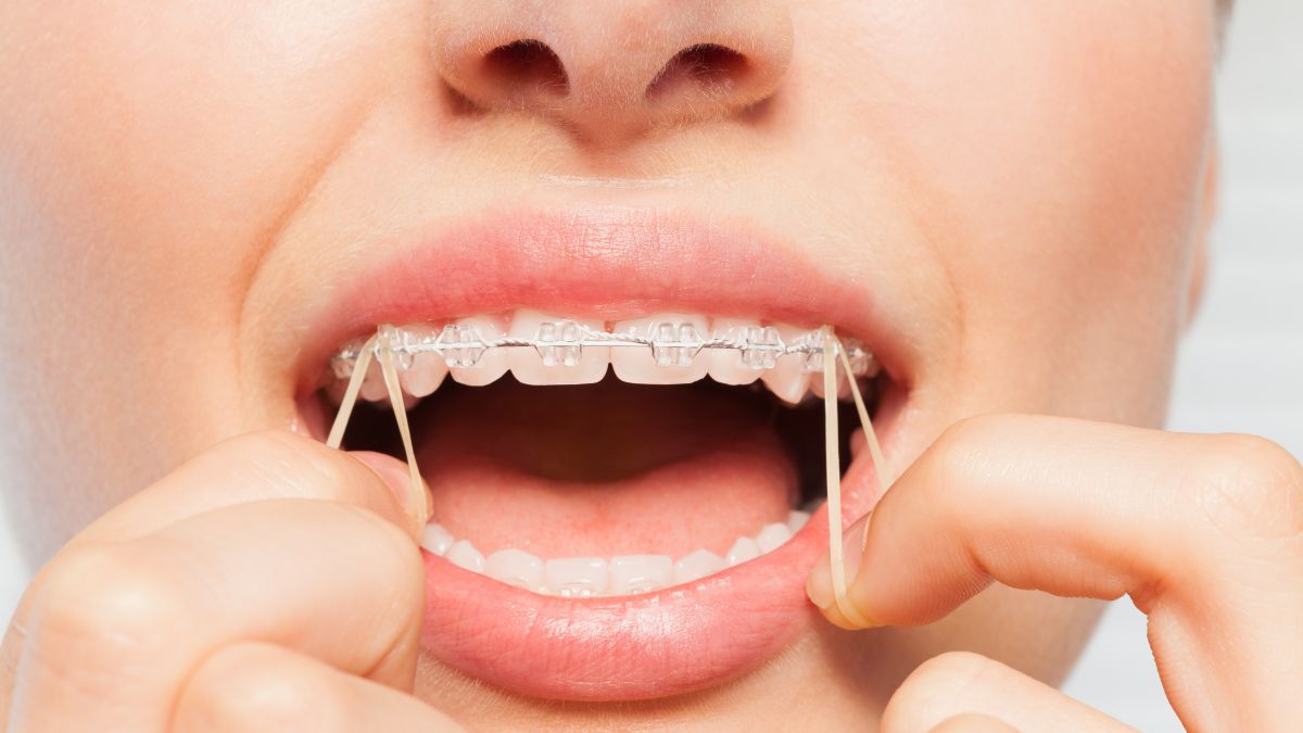 Braces Rubber Bands