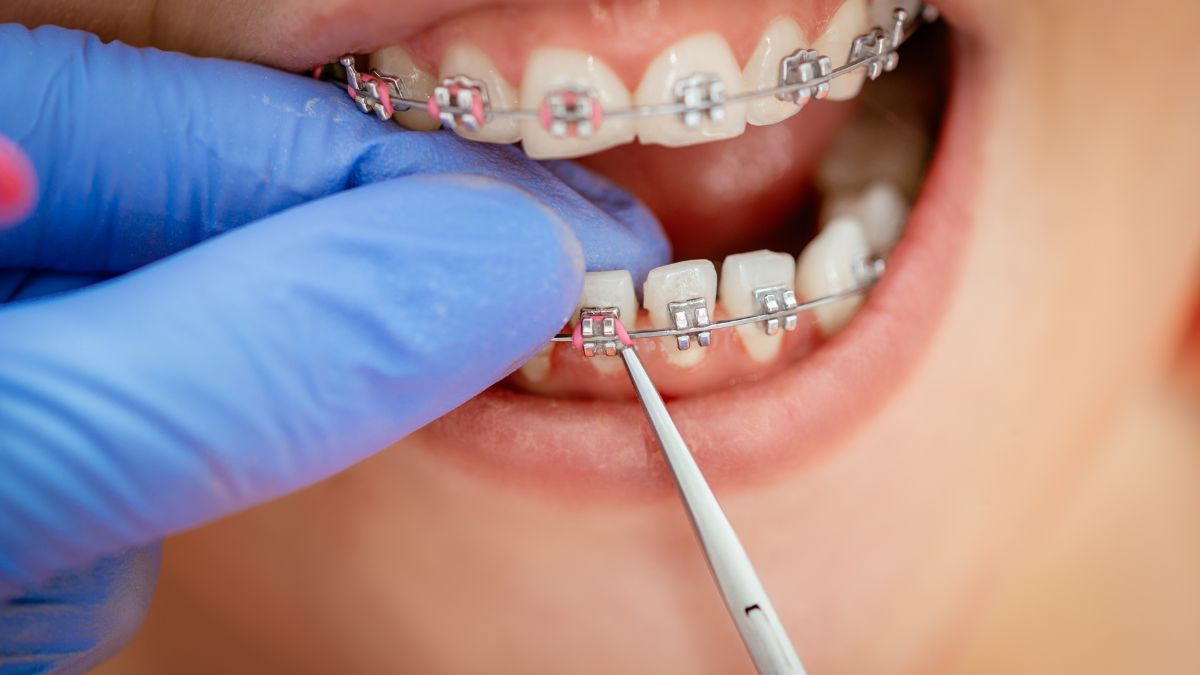 Braces Wax