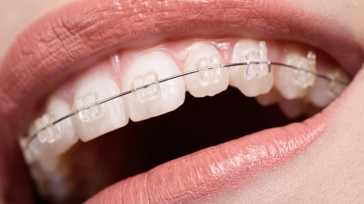 Braces Wire