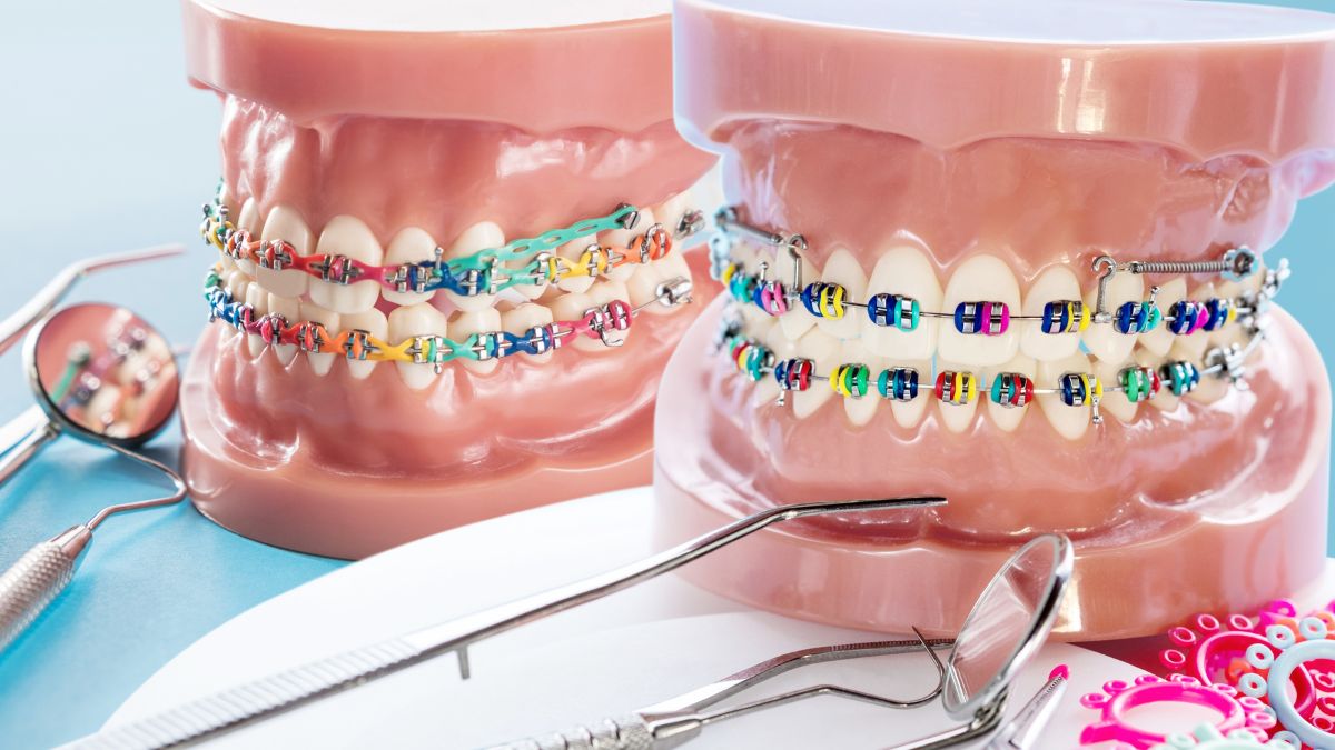 Braces