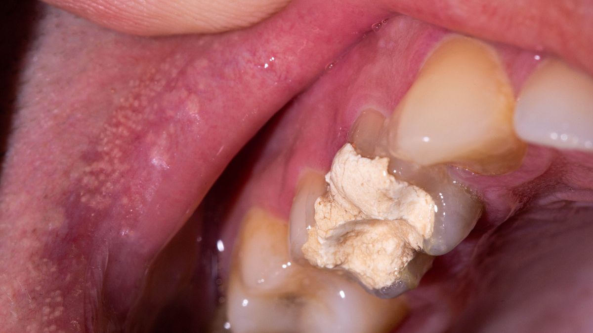 Dental Cement