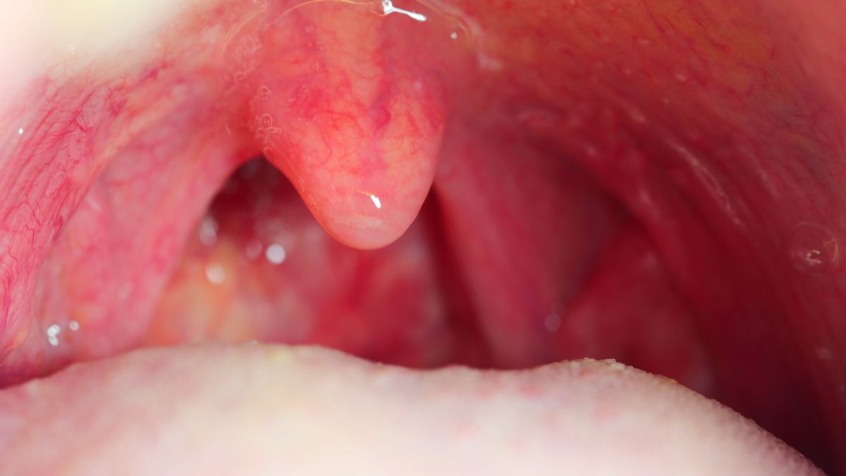 Tonsil Stones