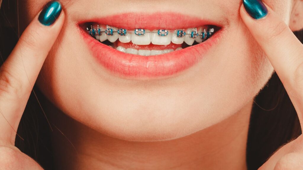 Drinking Soda with Braces What will Happen?